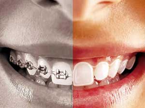 Diş-telleri-ve-Invisalign