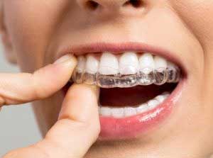 invisalign